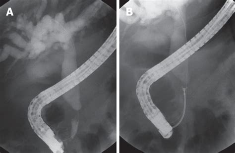 Successful Endoscopic Treatment Of Biliary Stricture Following