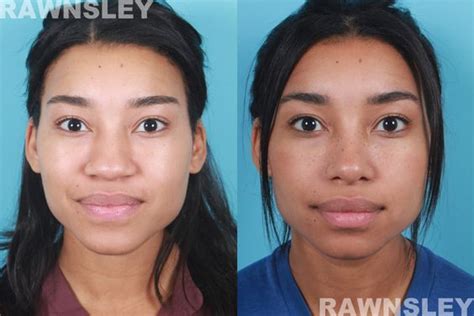 Mixed Race Rhinoplasty Rhinoplasty Nose Jobs Nose Surgery Rhinoplasty Nose Surgery