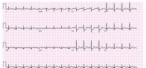 Ekg Showing St Elevation In Leads Ii Iii And Avf With St Depression In