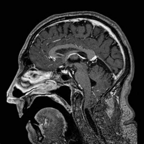 Subependymoma Contrast Enhanced Sagittal T1 Weighted Image Shows A