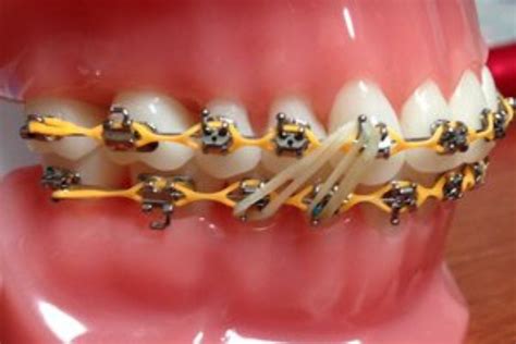 How Do Elastic Bands Work On Braces Jewell Lai