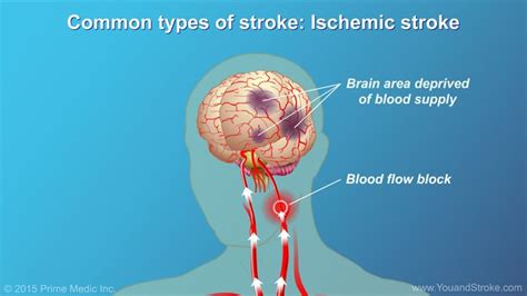 Pin On Animated Stroke Patient Slides