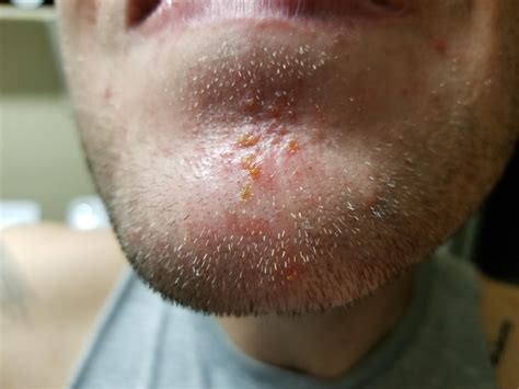 Folliculitis Or Acne On My Chin General Acne Discussion