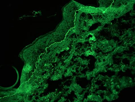 Bullous Pemphigoid Immunofluorescence