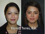 Photos of Payment Plans For Rhinoplasty