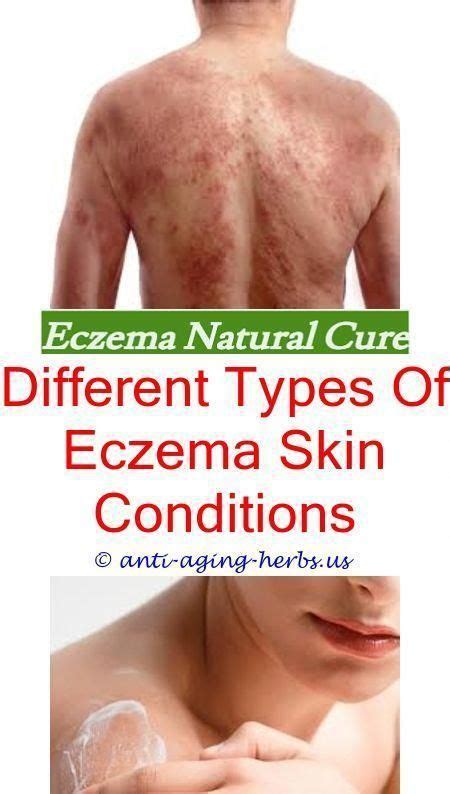 How Long Baby Eczema Lastsigns Of Eczema On Handshow To Clear Up