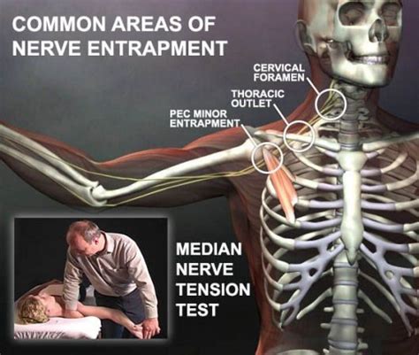 Anatomy Of Nerve Entrapment Shows The 3 Most Common Areas Where The