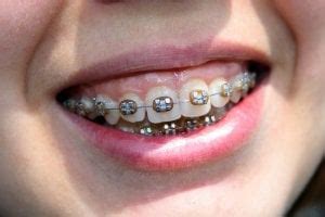 What Is An Overbite Braces Surgery For Correction Dentaly Org