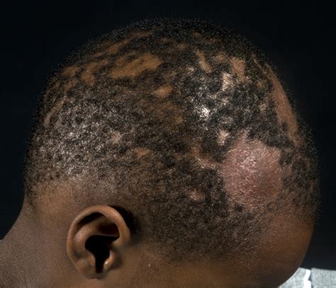The Diagnosis And Management Of Tinea The Bmj