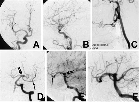 Figure From Infraoptic Course Of The Anterior Cerebral Artery Originating From The Extradural