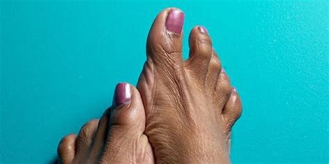 Why Do Diabetics Have Foot Problems —
