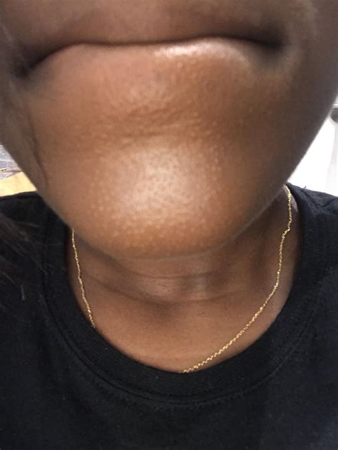 Skin Concern I Always Have These Bumps That Looked Like Clogged Pore