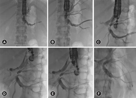 Pdf Endoscopic Ultrasound Guided Intervention For Inaccessible