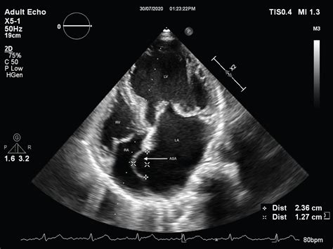 Atrial Septal Aneurysm Associated With Mitral Valve Prolapse Syndrome