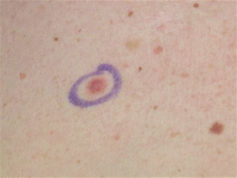 Melanoma Symptoms In Body Doctor Heck