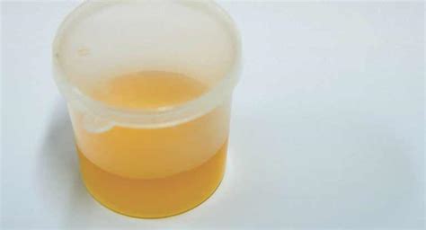 Leukocytes In Urine What You Should Know