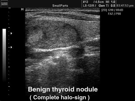 Ultrasound Images • Thyroid Benign Nodule B Mode Echogramm №216