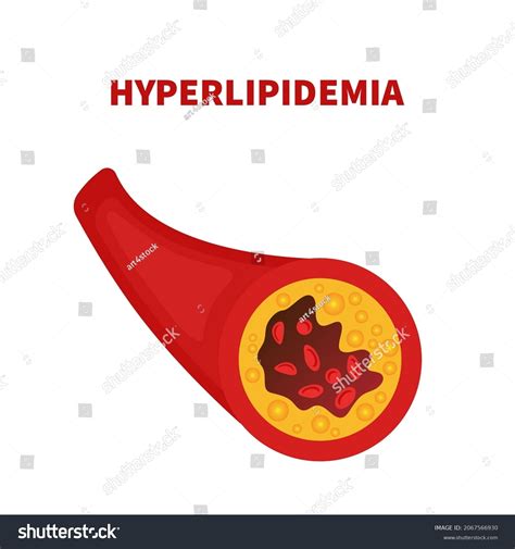 Hyperlipidemia Disease Narrowed Blood Artery Vessel Stock Vector