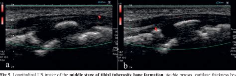 Osgood Schlatter Disease In Ultrasound Diagnostics A Pictorial Essay