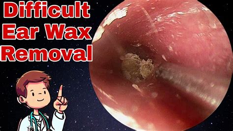 Difficult Ear Wax Removal Close To The Eardrum Youtube
