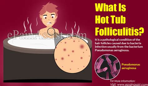 Folliculitis Pictures Symptoms Treatment And Prevention