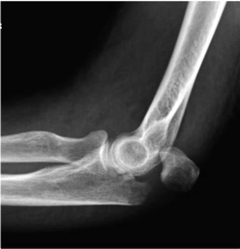 Olecranon Olecranon Fracture Wikipedia This Notch Is Called The