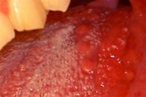 Bumps On Back Of Tongue White Large Red Lumps Std Sore Throat