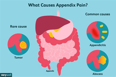 Appendix Pain Causes Treatment And When To See A Doctor
