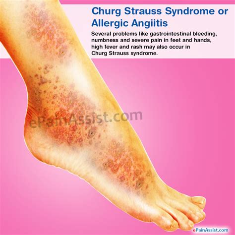 Churg Strauss Syndrome Or Allergic Angiitissymptomstreatment