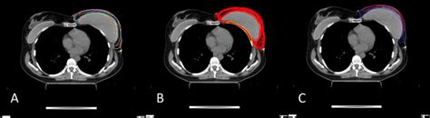 Estro Acrop Consensus Guideline For Target Volume Delineation In The