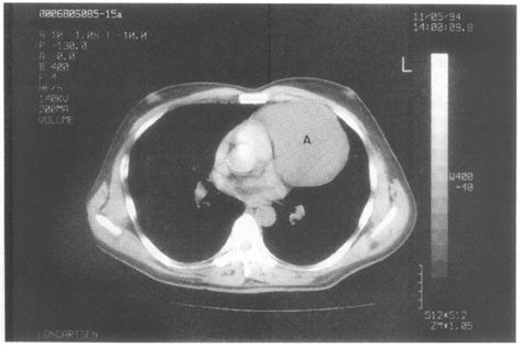 Ct Image Of Case 1 The Cyst A Is Localised At The Left Side Of The