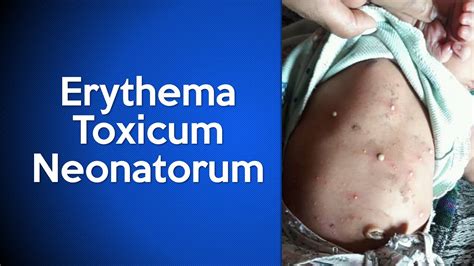 Erythema Toxicum Neonatorum Youtube
