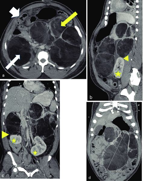 Fat Containing Retroperitoneal Masses In A 45 Year Old Male Presenting