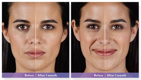 Juvederm Vollure Before And After Forever Flawless