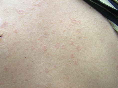 Hiv Rash Chest