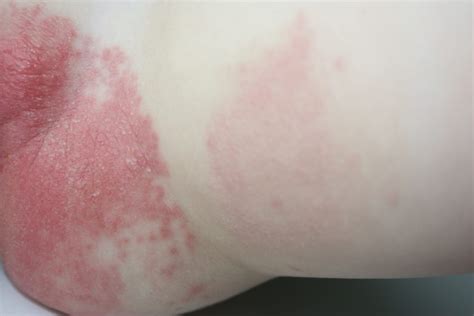 7 Common Types Of Skin Rashes In The Philippines Images And Photos Finder