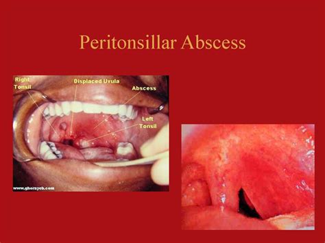 Peritonsillar Abscess Anatomy