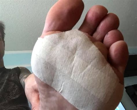Distal Forefoot Blisters A Confusing Blister Location Blister Prevention