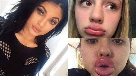 The Kylie Jenner Lip Challenge Has Turned Into A Complete Disaster Pics