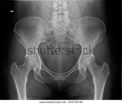 Radiography Female Pelvis Ap Stock Photo 343740746 Shutterstock