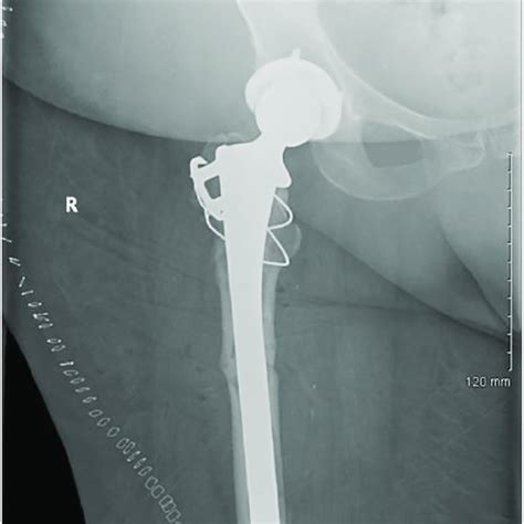 Anteroposterior X Ray Of Right Hip With Periprosthetic Subtrochanteric