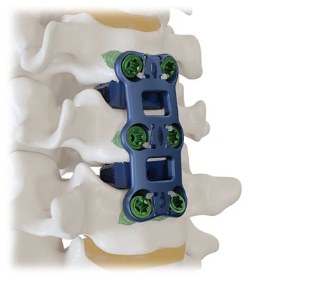 Resonate™ Anterior Cervical Plate System Globus Medical