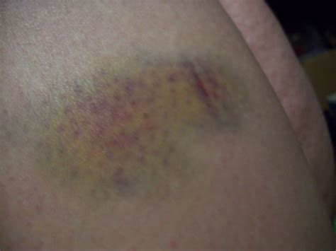 Pictures Of Bruises On Legs Wildcard Reining