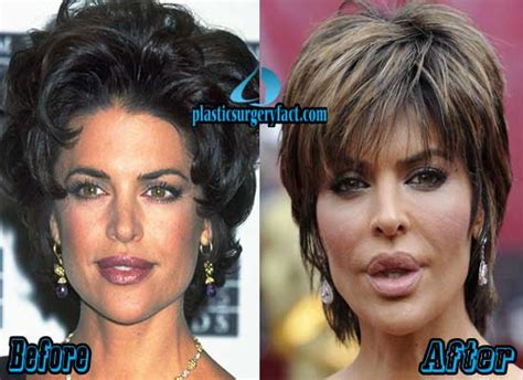 Lisa Rinna Plastic Surgery Before And After Photos Plastic Surgery Facts