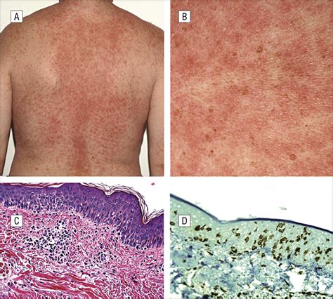 Skin Reactions In A Subset Of Patients With Stage Iv Melanoma Treated