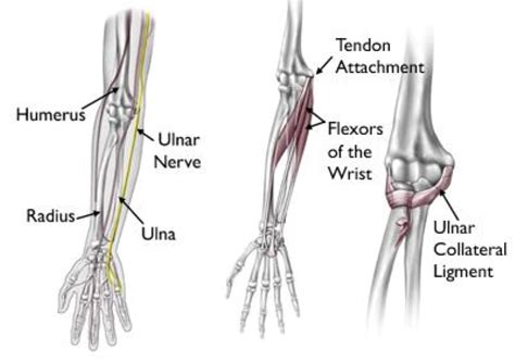Symptoms of a torn tendon include pain, swelling, joint restriction, popping and knot formation. Elbow Injuries in the Throwing Athlete - OrthoInfo - AAOS