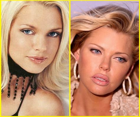 10 Celebrity Plastic Surgery Disasters Before And After