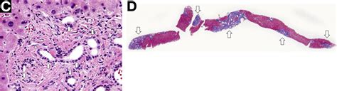 Esophageal Varices Gastroenterologists In Florida Hot Sex Picture