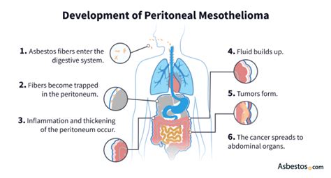 Peritoneal Mesothelioma Causes Symptoms And Life Expectancy