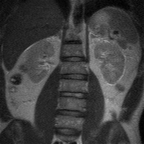 CT And MR Imaging For Evaluation Of Cystic Renal Lesions And Diseases